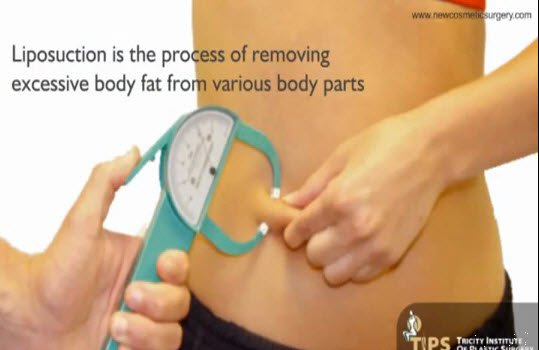 Liposuction Surgery in India'
