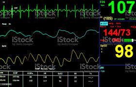 ECG Monitor Market