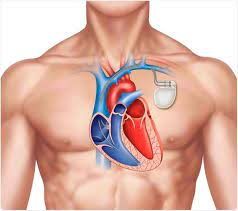 Medical Pacemaker Market'