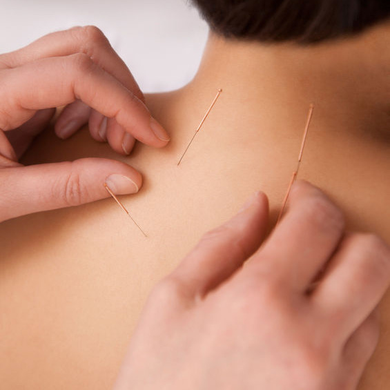 Acupuncture'