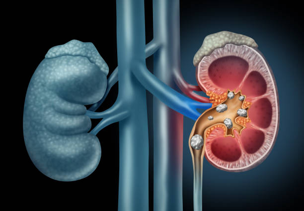 Kidney Stone Therapy Market'
