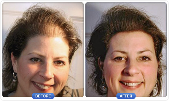 Provillus Hair loss'