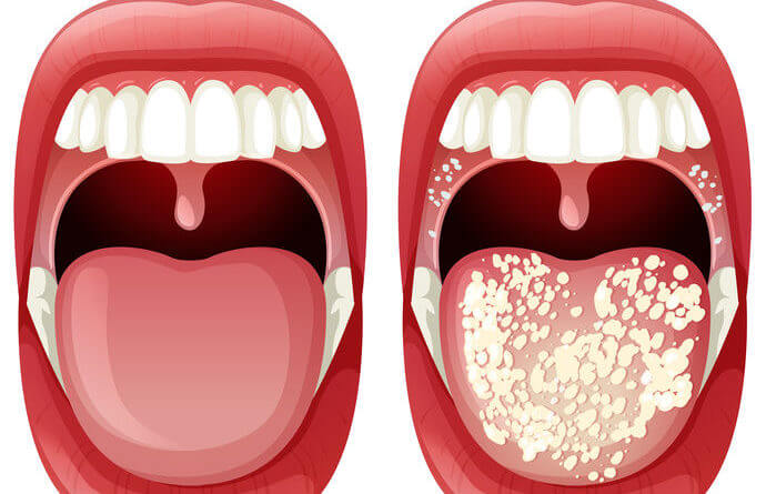 Oral Antifungal Medication Market