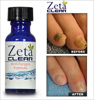 Nail Fungus Treatment'
