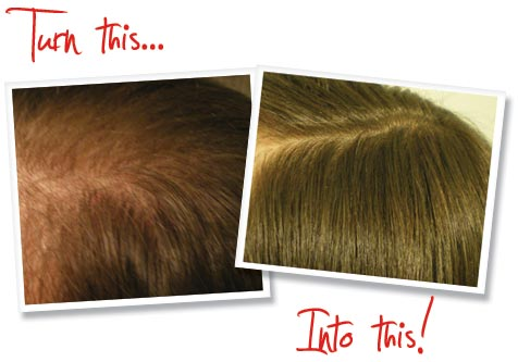Provillus Hair loss'