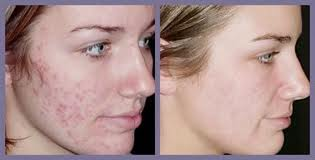 Clearpores Acne Treatment'