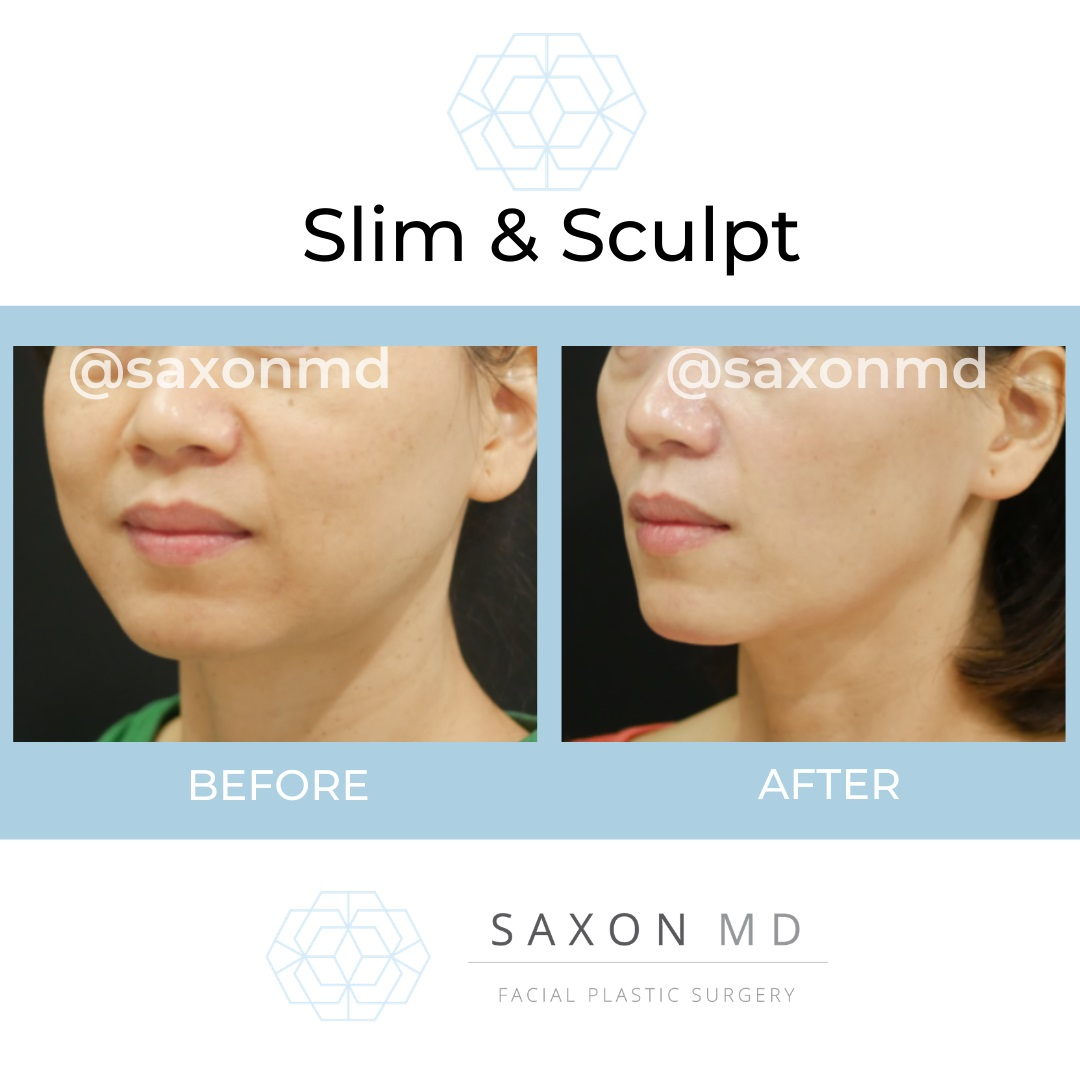 Blepharoplasty Austin'