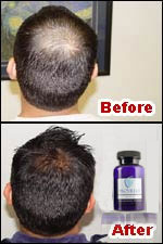 Provillus Hair loss'