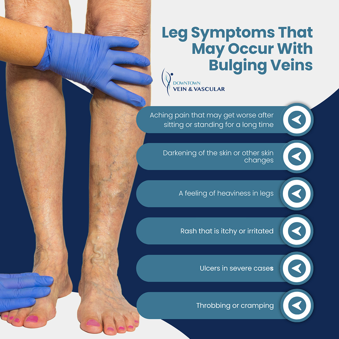 Leg Symptoms That May Occur With Bulging Veins'