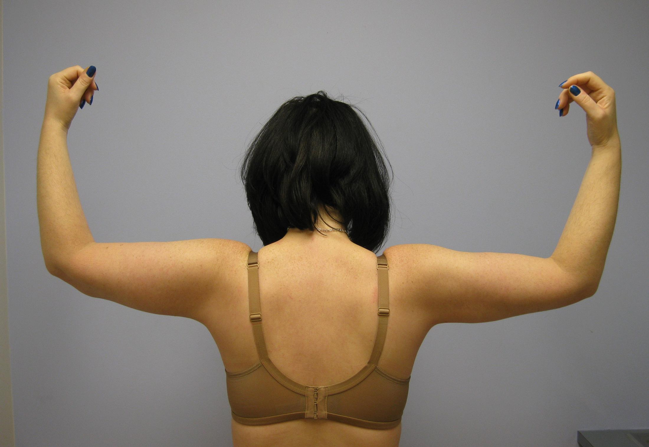 Body Lift New Jersey'