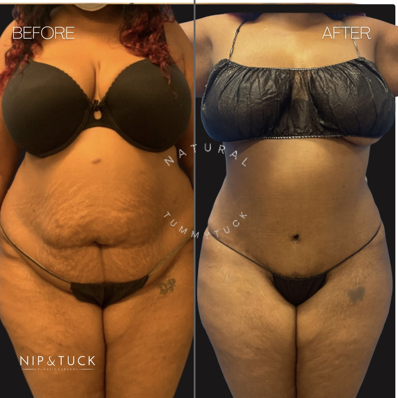 Abdominoplasty Atlanta'