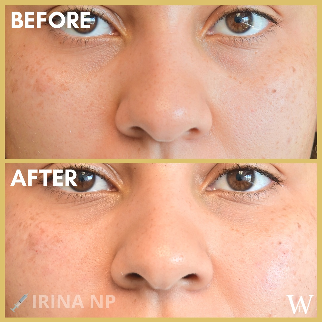 Brazilian Butt Lift Los Angeles'