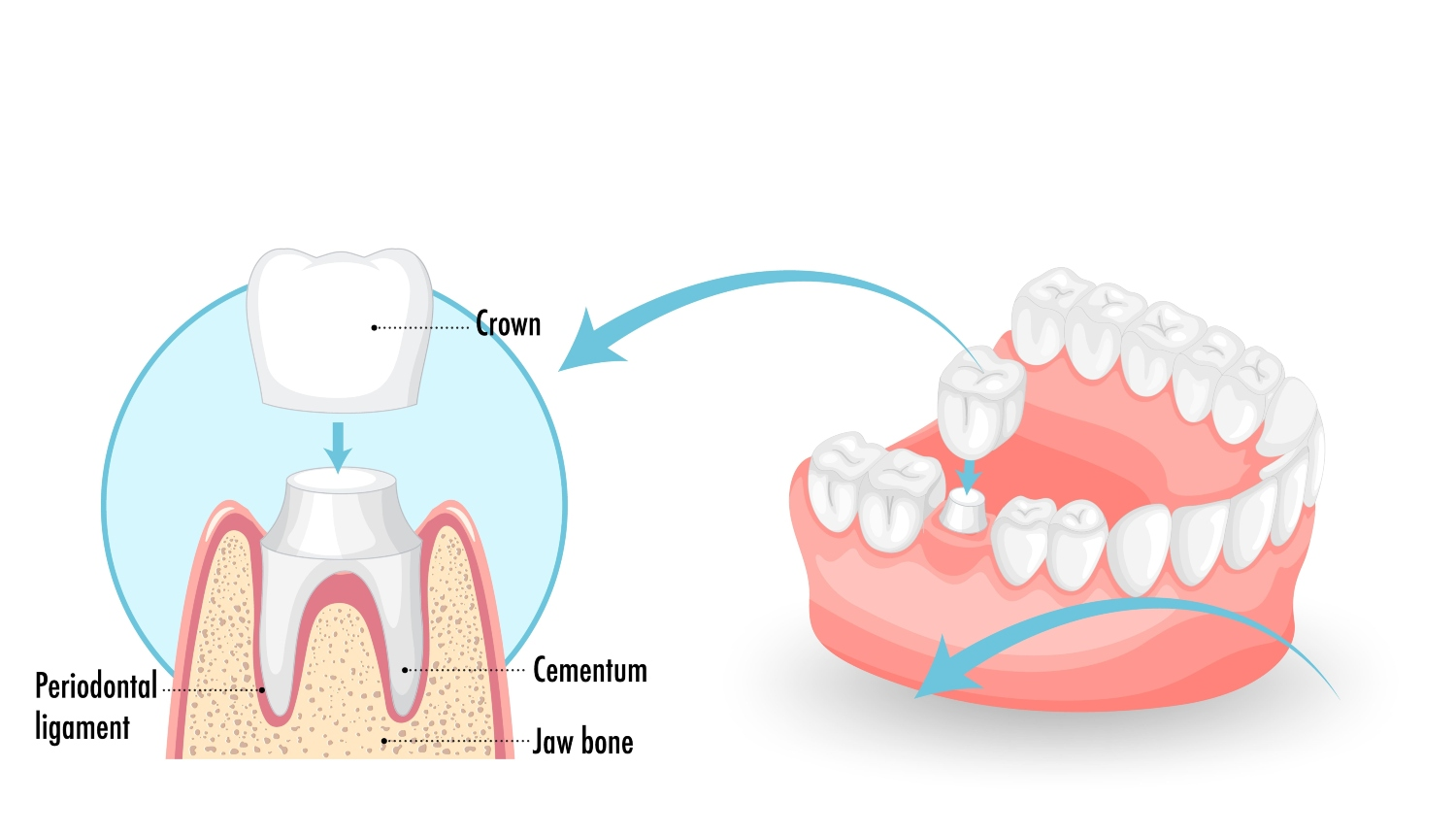 Dental Crowns'