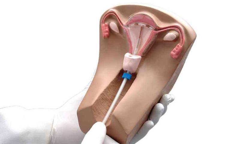 Intrauterine Devices Market'