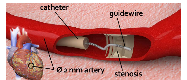 Cardiac Catheter & Guidewires Market