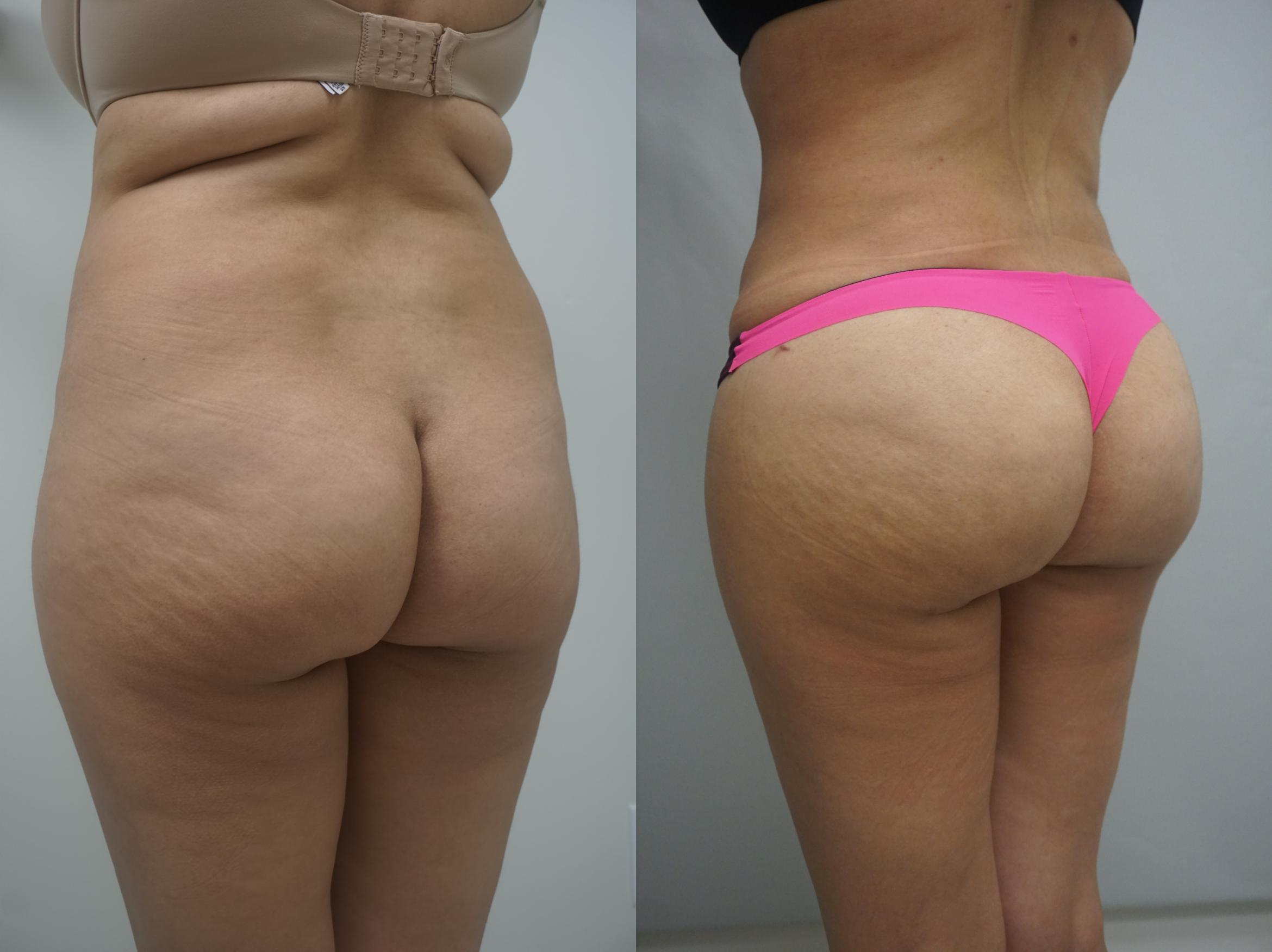 Liposuction Los Angeles'