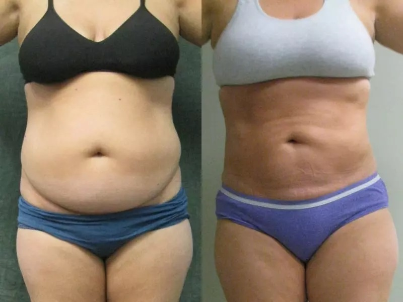 Tummy Tuck Los Angeles'