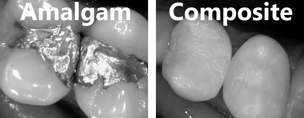 amalgam fillings'