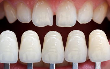 Doctor Suggests The Greatest Health Benefit of Porcelain Ven'