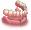 Implant Denture'