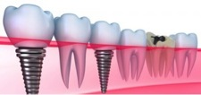 Dental Implant