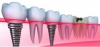 Dental Implant'