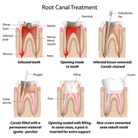 Root Canal Safety