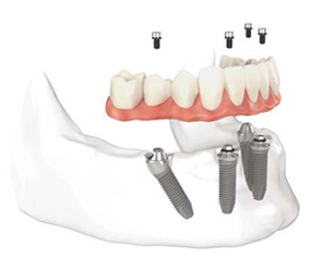 DentalImplantsUKLondon.co.uk
