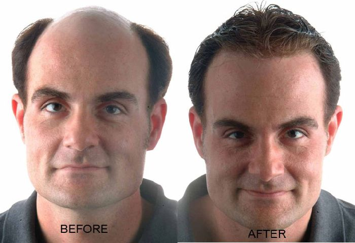 Provillus Hair loss'