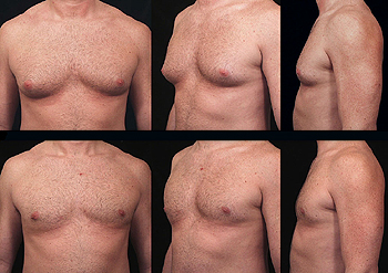 Male Breast Reduction'