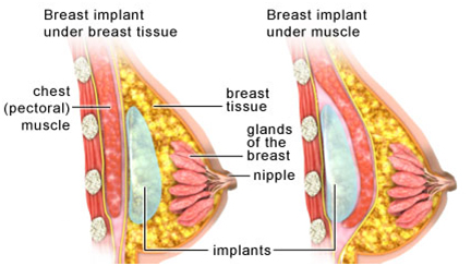Breast Enlargement in India'