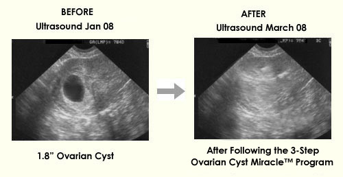 Ovarian Cyst Miracle Review'