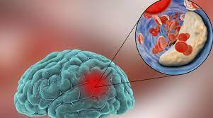 Transient Ischemic Attack Market'