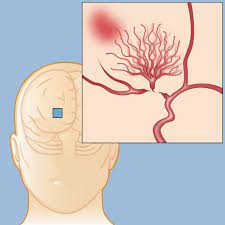 Moyamoya disease Market'