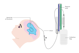 External Ventricular Drain Market'