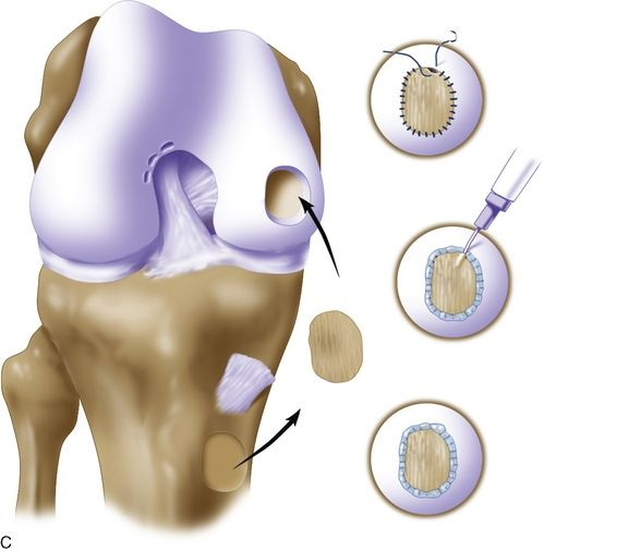 Cartilage Repair Market'