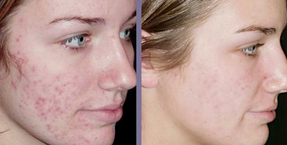 Revitol Scar Cream'
