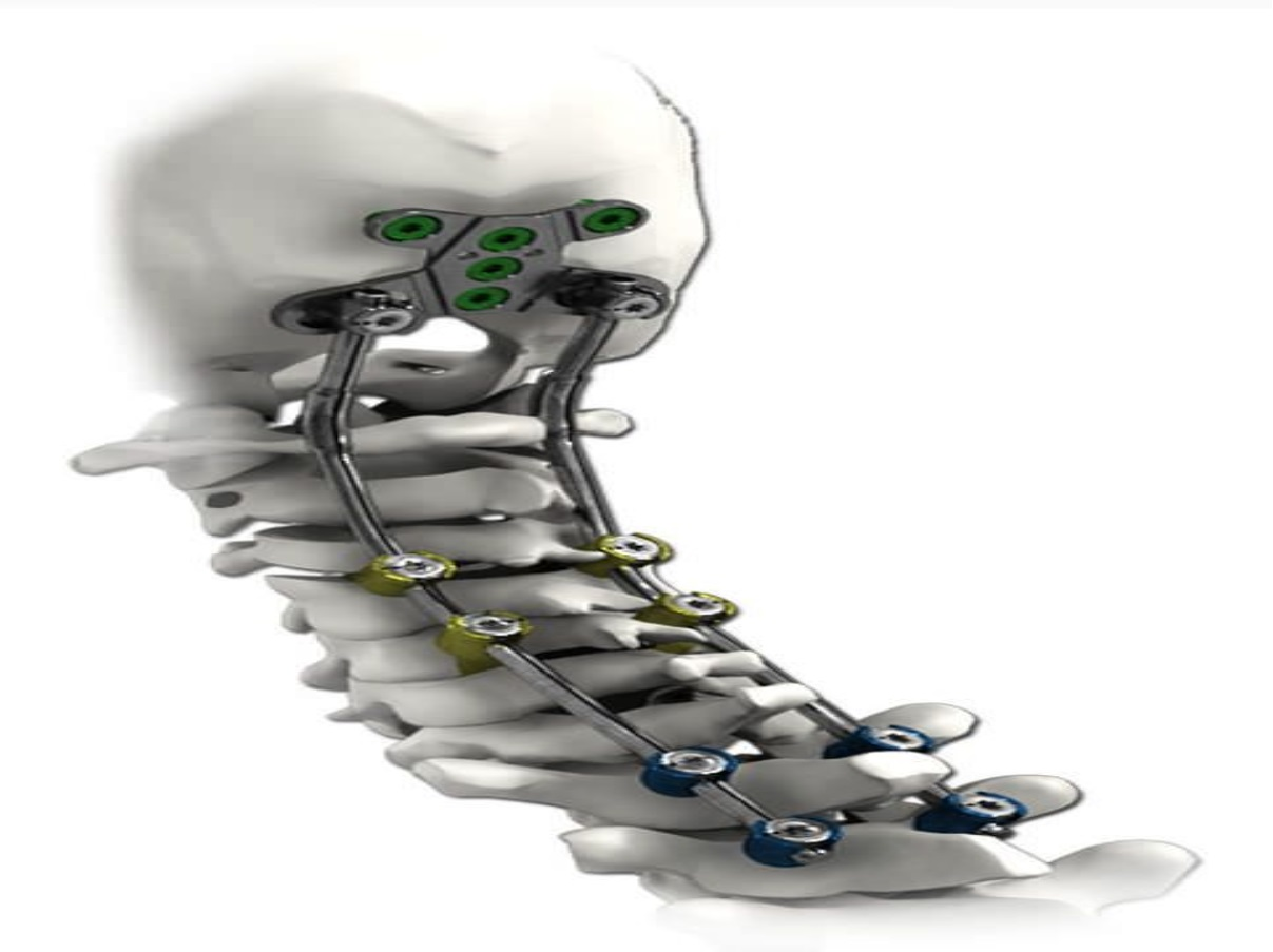 Spinal Implants Market'