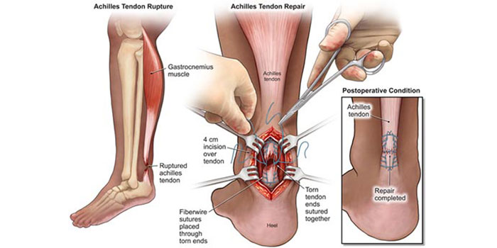 Tendon Repair Market'