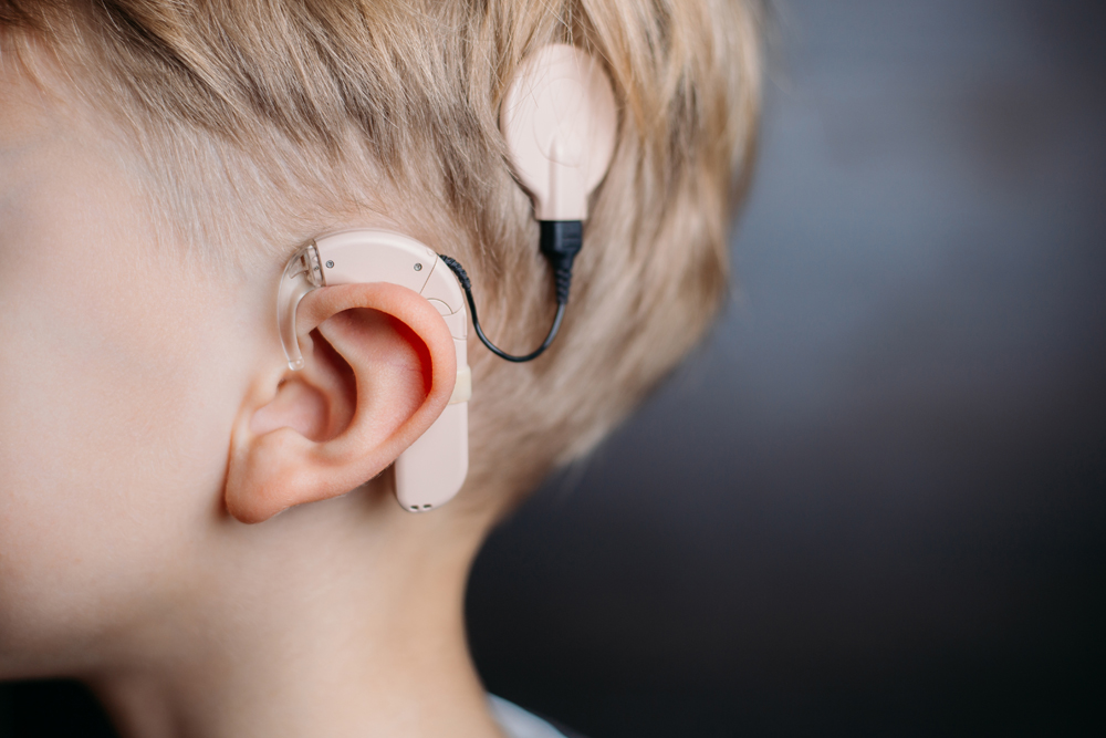 Cochlear Implant Market'