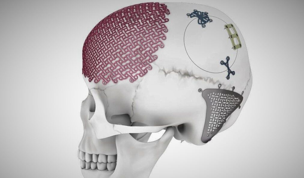 Craniomaxillofacial Devices Market'