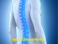 Spine Osteoarthritis Market