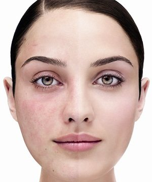 Revitol Rosacea Cream'