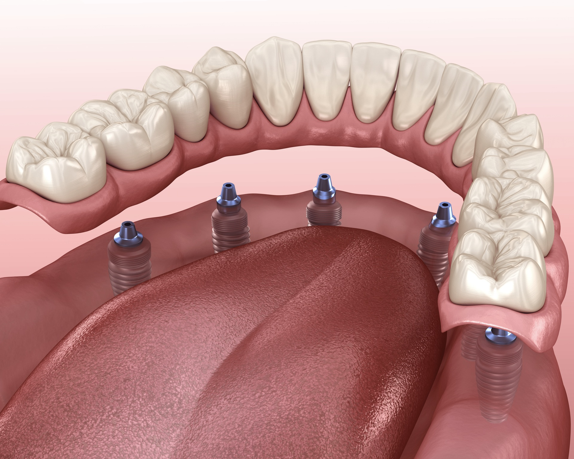 Veneers San Diego'