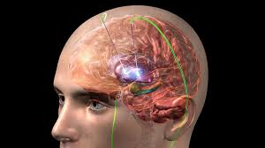 Deep Brain Stimulation Market'