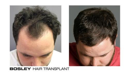 Company Logo For Bosley - Hair Restoration &amp; Transpl'