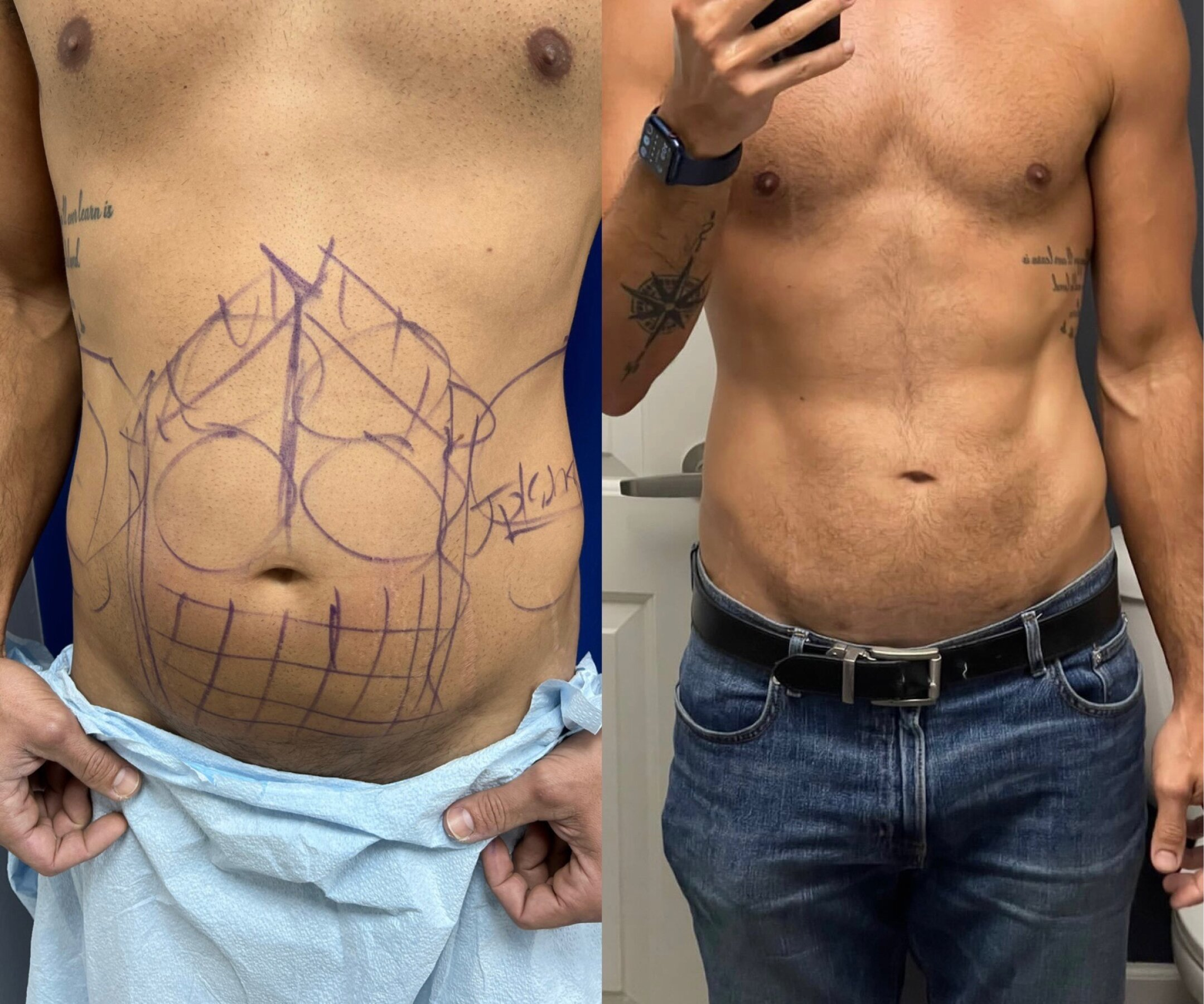 Gynecomastia Surgery Miami'