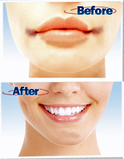 Angular Cheilitis Cure'