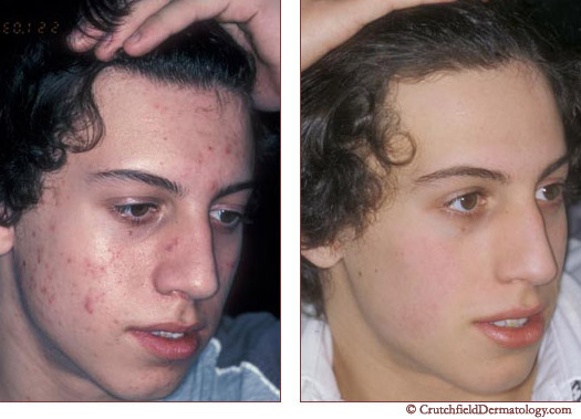 Revitol Scar Cream'