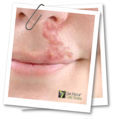 cold sore near nose2